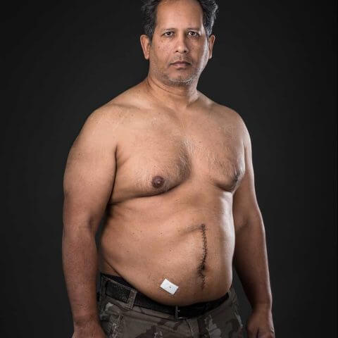 Cancer Free | Self portrait, ten days after a colon cancer operation. This was taken about an hour before the staples over the wound were removed | Iris Awards 2016 | Portrait Classic Category | Bronze