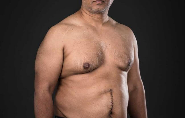 Cancer Free | Self portrait, ten days after a colon cancer operation. This was taken about an hour before the staples over the wound were removed | Iris Awards 2016 | Portrait Classic Category | Bronze